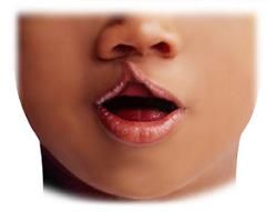Labio leporino