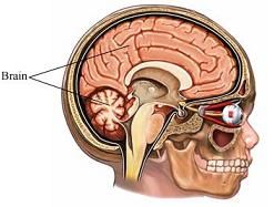 Parálisis cerebral Parálisis cerebral
