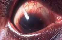 Glaucoma Glaucoma