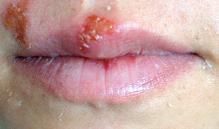 Herpes