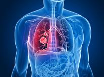 Pulmonía