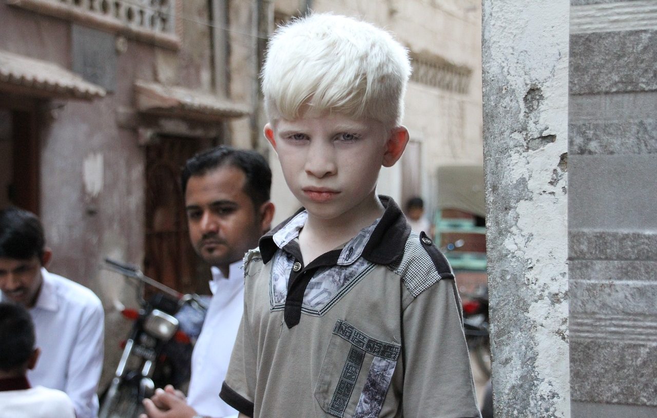 Niño albino