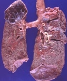 Fibrosis