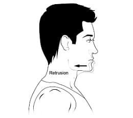 Retrusión