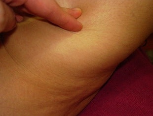 Celulitis